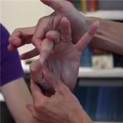 Cubital Tunnel Syndrome