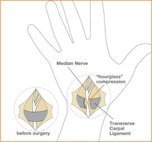 Carpal Tunnel Treatment Coral Springs 