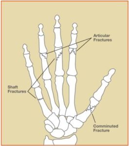 HandFracture_Fig1