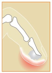 HandInfection_Fig3