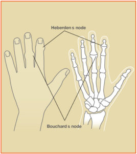 Osteoarthritis_Fig2