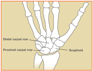 ScaphoidFracture_Fig1