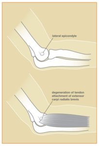 TennisElbow_Fig1