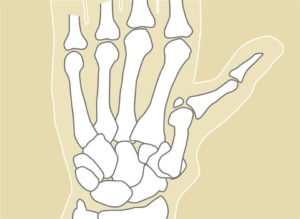 ThumbArthritis_Fig2