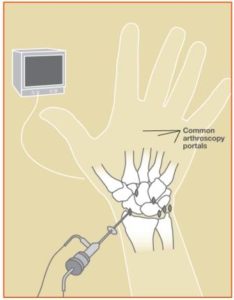 WristArthroscopy2