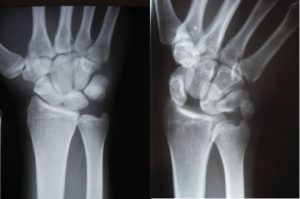 Wristsprains_image3