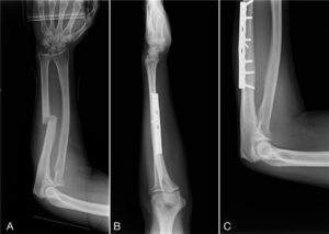 humerus fracture_from textbook