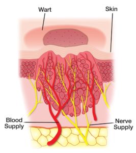 wart-dagram (3)